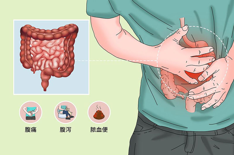 腹痛，谨防溃疡性结肠炎